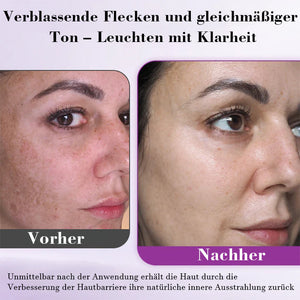 Fortschrittliches Anti-Pigmentierungsserum
