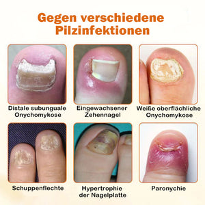 Bienengift-Nagelreparaturspray